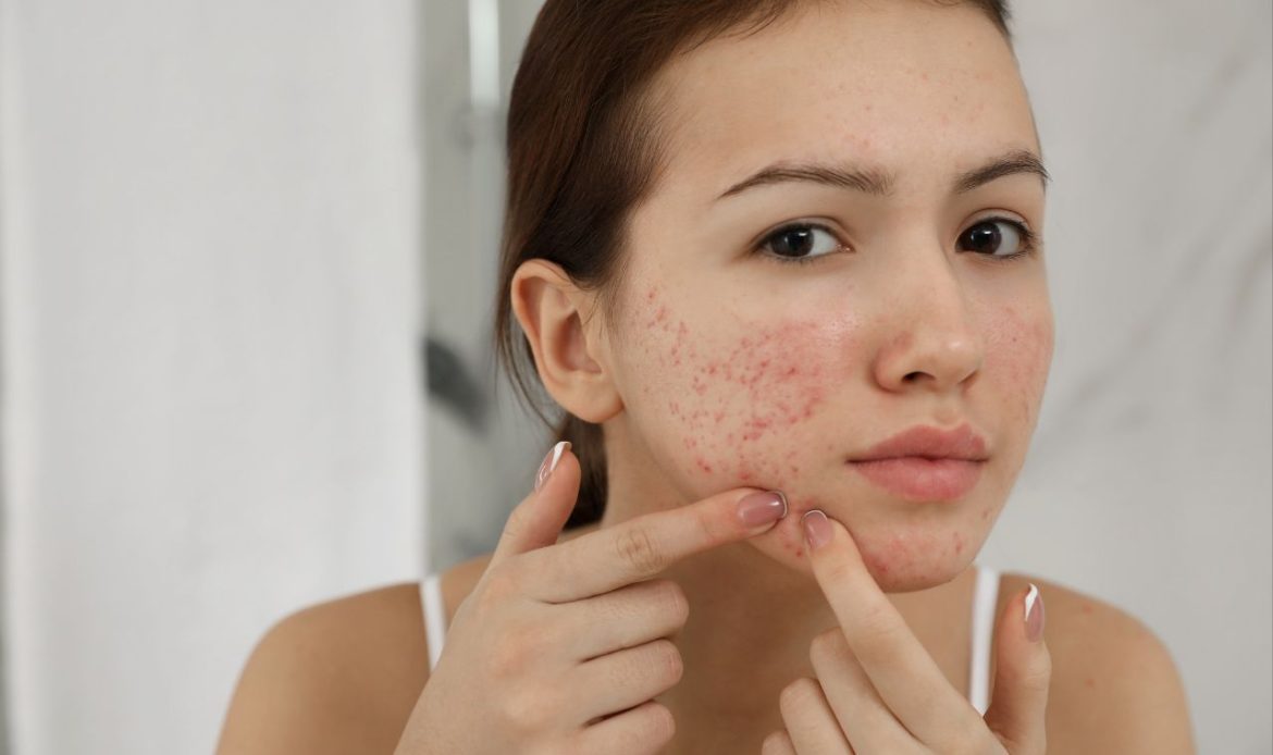 Close-up of a teenager with acne seeking support through homeopathy for kids and teens