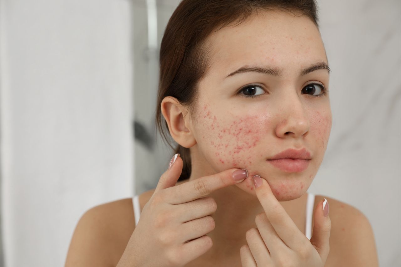 Close-up of a teenager with acne seeking support through homeopathy for kids and teens
