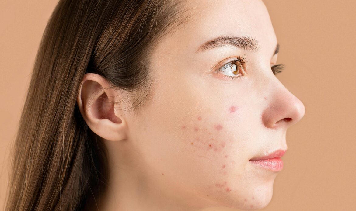 teen with Eczema which begs the question; Does Homeopathy Help Eczema?​